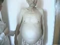 Ascites]