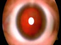 ophthalmoscopy
