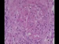 LUPUS NEPHRITIS