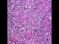 Lymph sarcoma